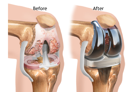 OA Zamjena koljena: Prije i poslije